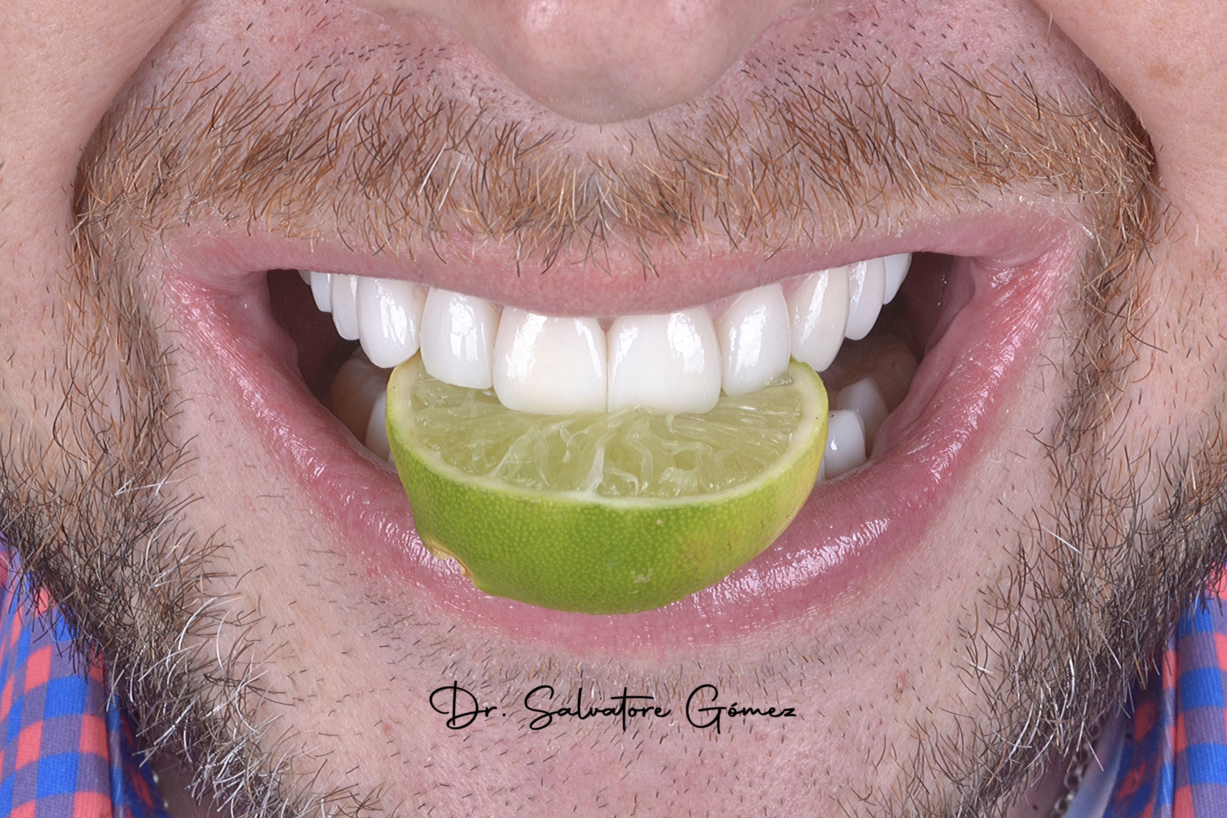 Sonrisa perfecta con carillas de porcelana en Miami