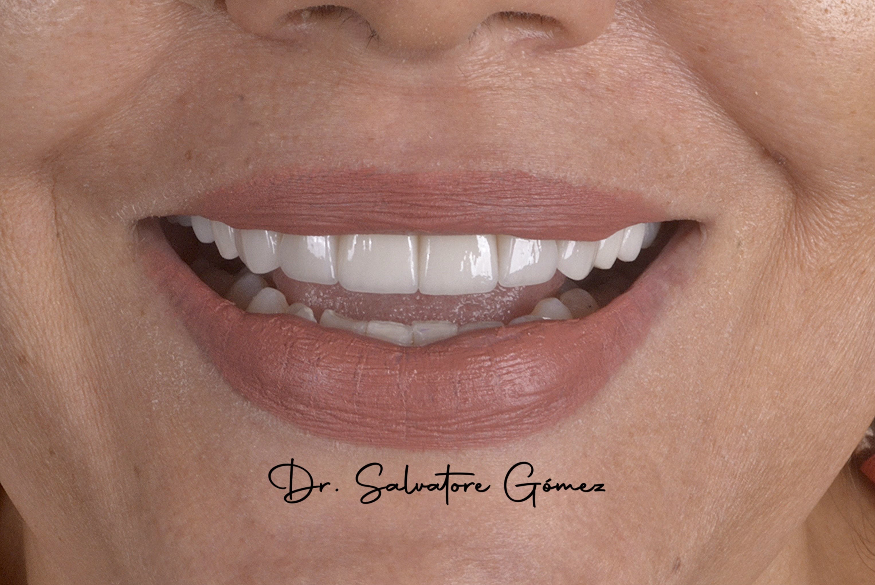 Implantes dentales de alta calidad en Miami