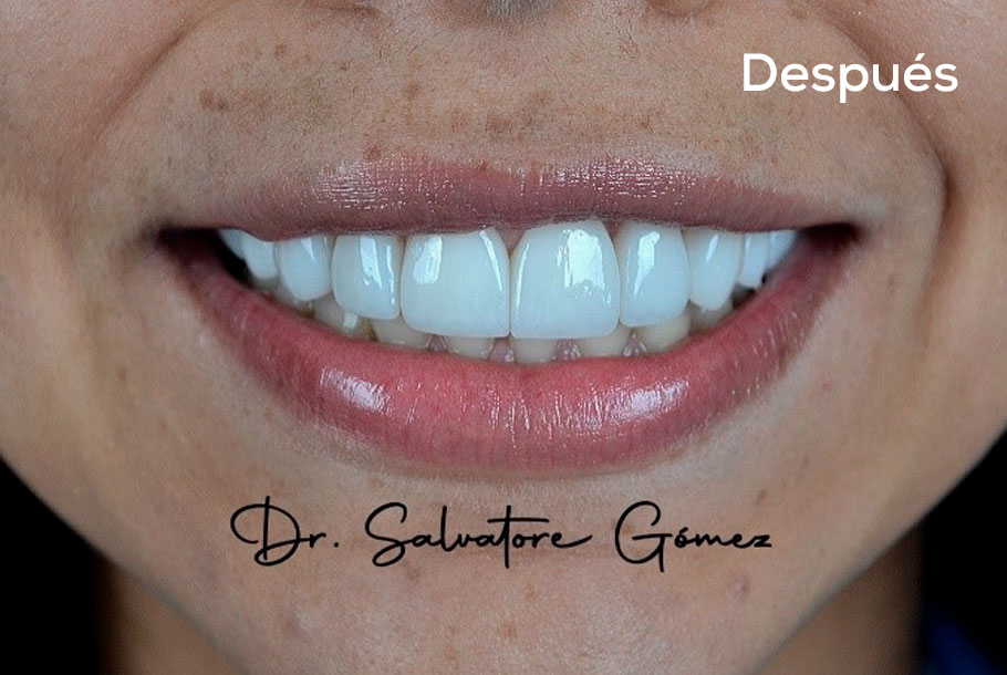 Diseño de sonrisa en Barranquilla Dr. Salvatore Gomez