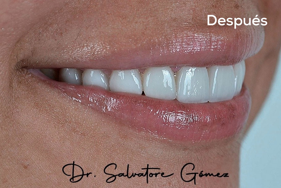 Diseño de sonrisa en Barranquilla Dr. Salvatore Gomez