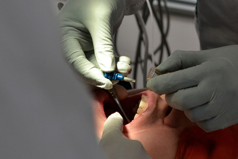 Implantes dental en Barranquilla