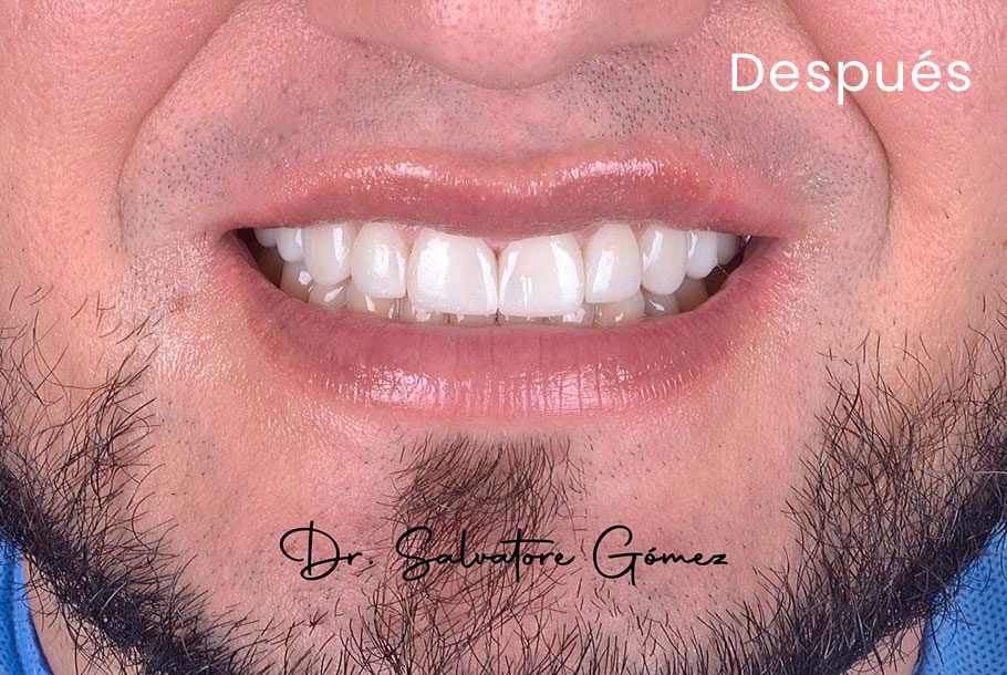 Diseño de sonrisa en Barranquilla Dr. Salvatore Gomez